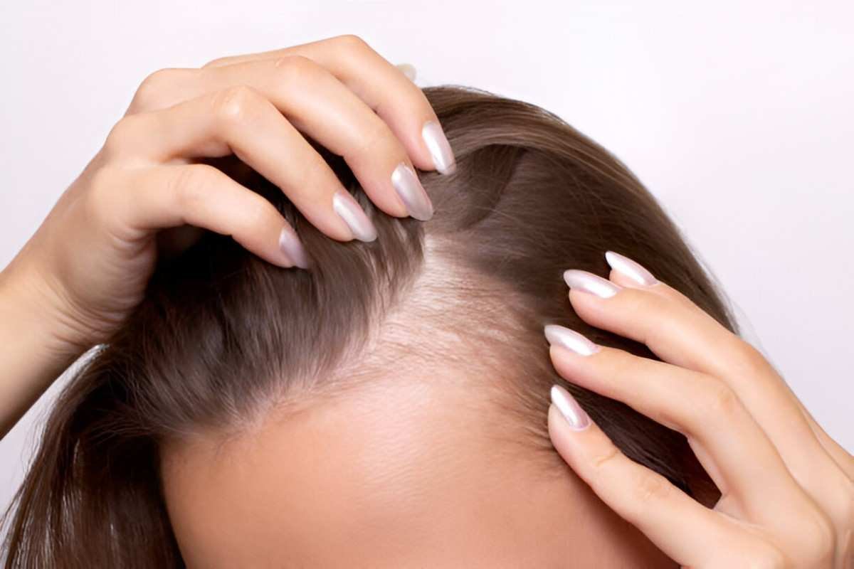 Alopecia