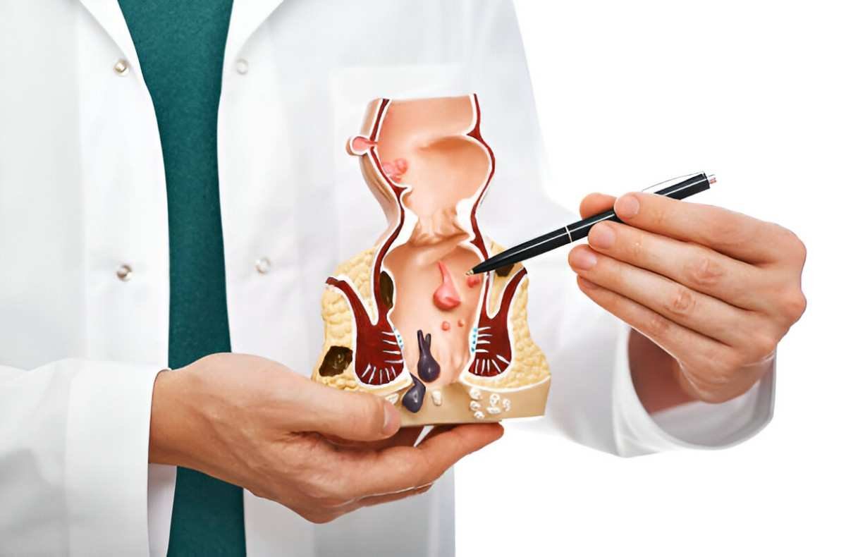 Anal Fissures