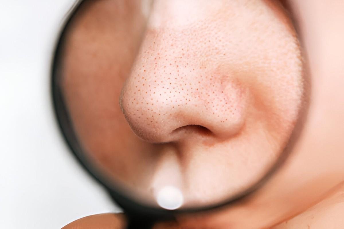 Blackheads