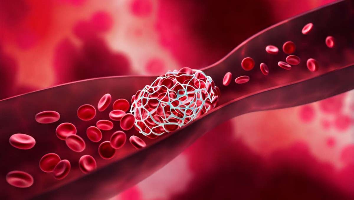 Blood Clots