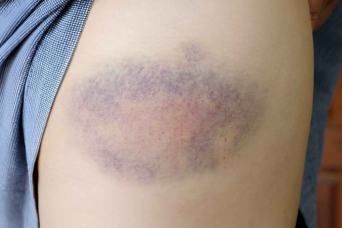 Bruises