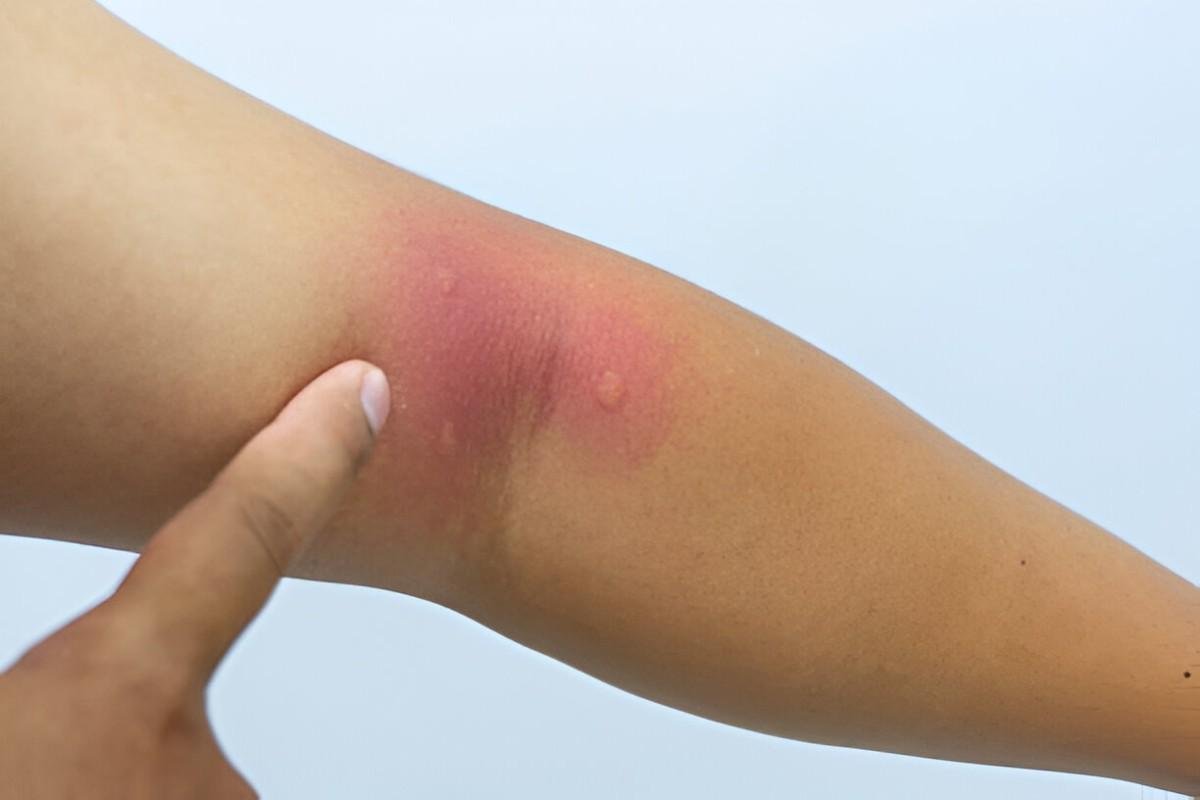 Bug Bites