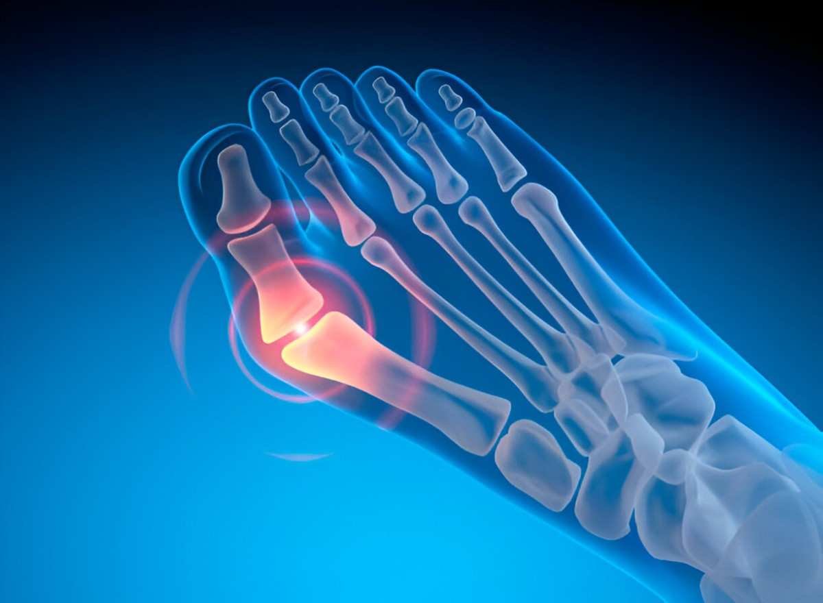 Bunions