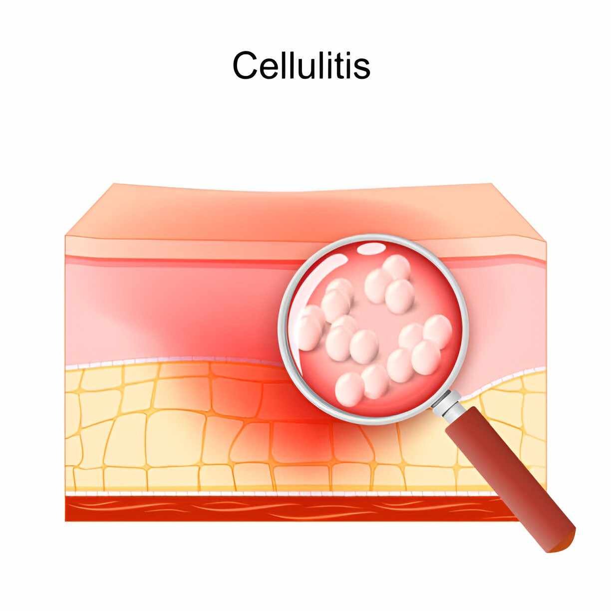 Cellulitis