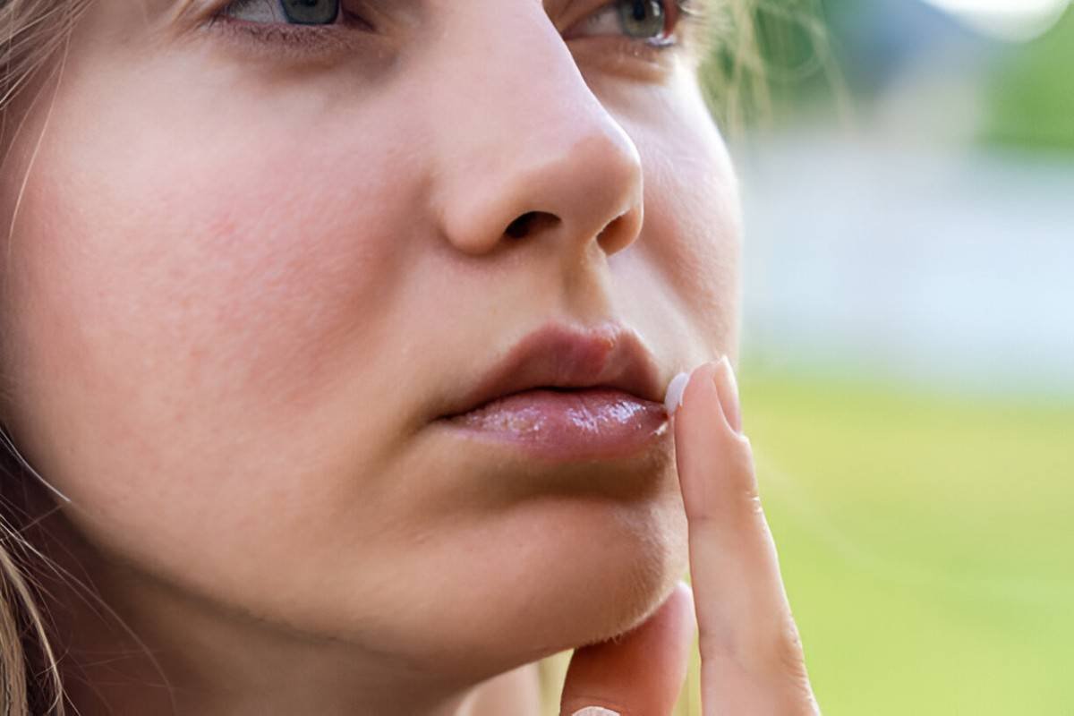 Chapped Lips