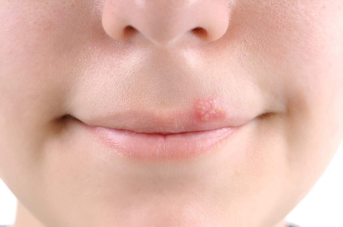Cold Sores on Lips