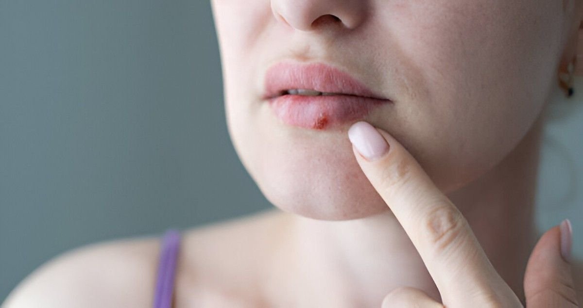 Cold Sores