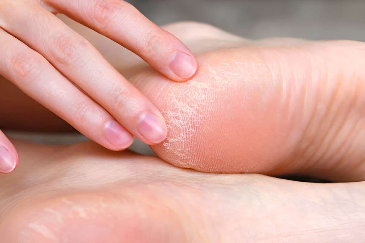 Cracked Heels