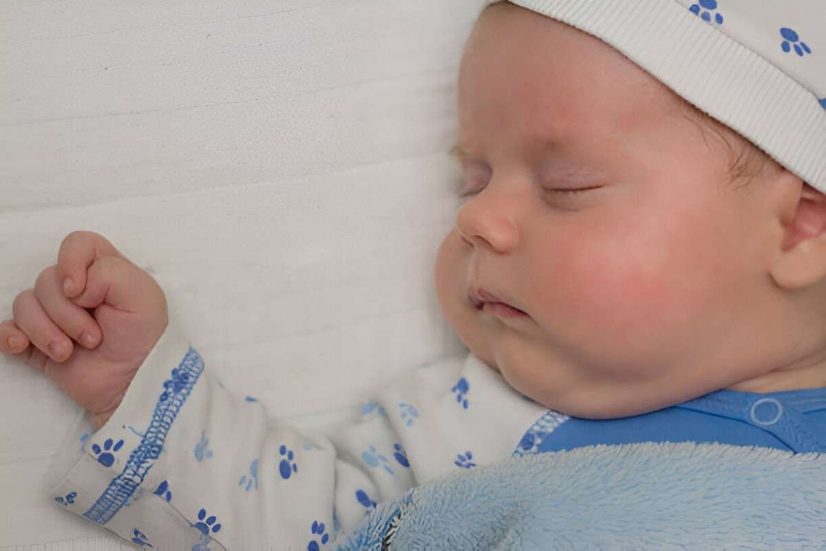 Cradle Cap
