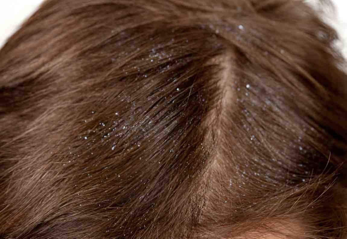 Dandruff