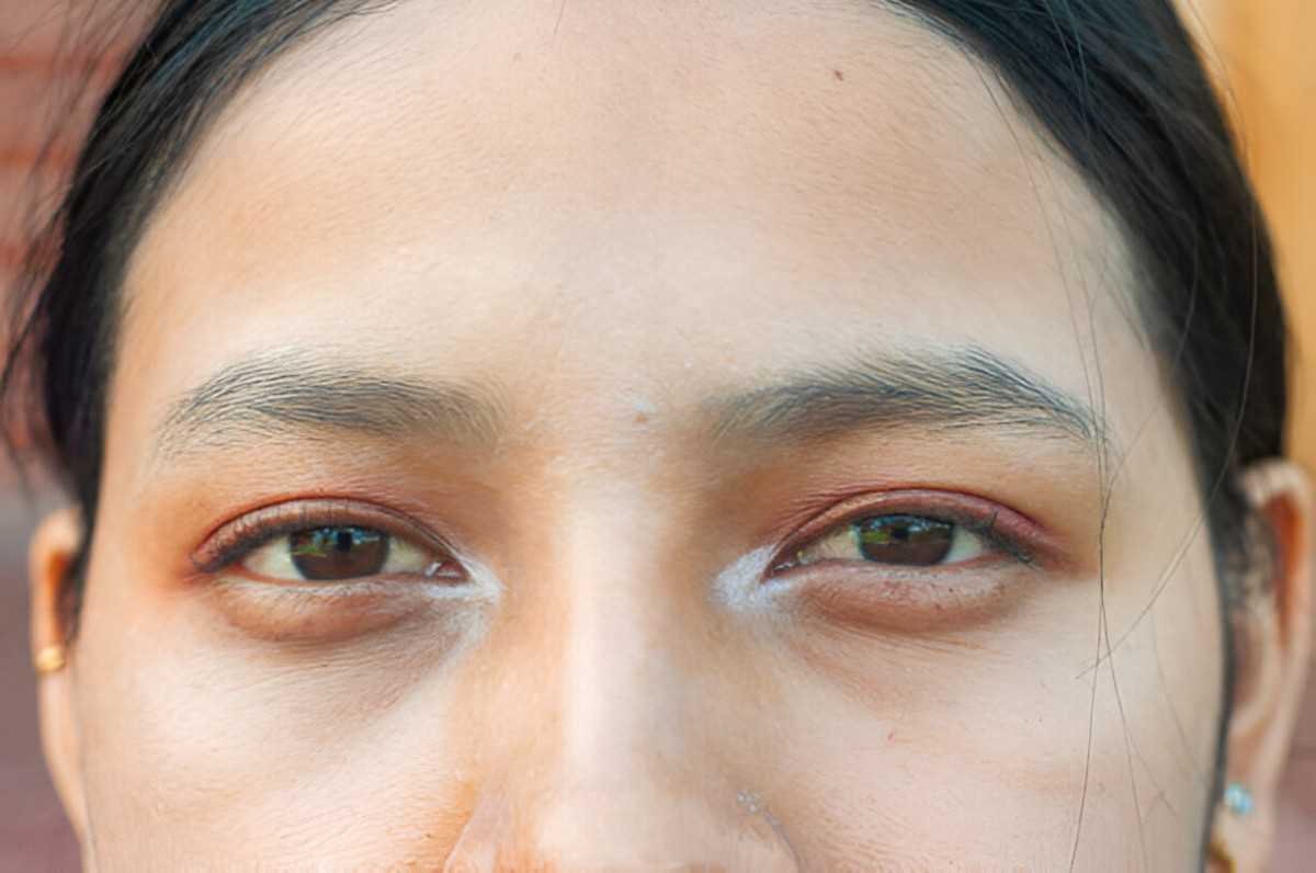 Dark Circles