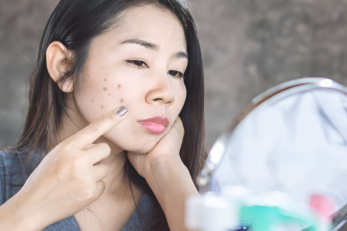Dark Spots on Face
