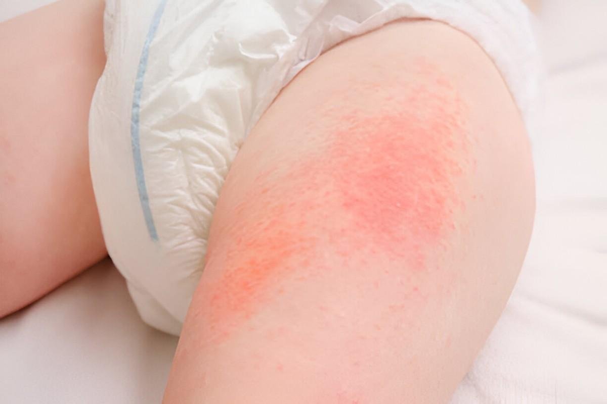 Diaper Rash