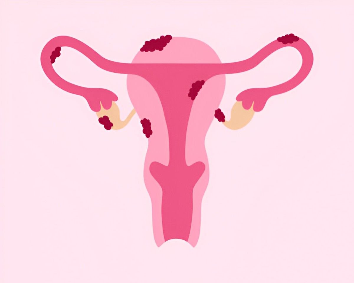 Endometriosis