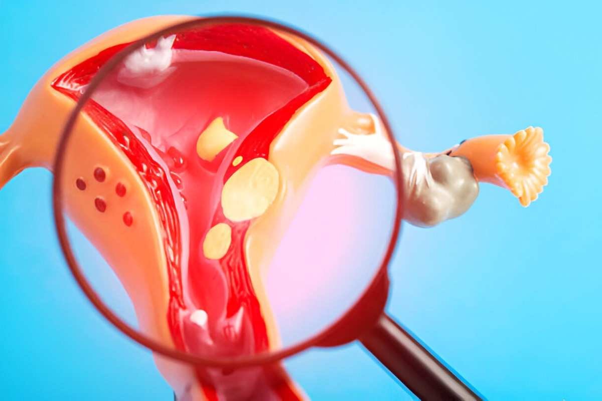 Fibroids