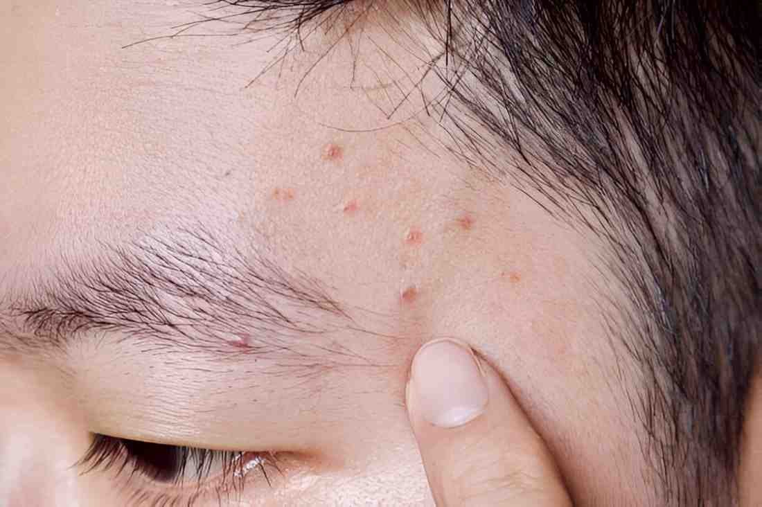 Folliculitis