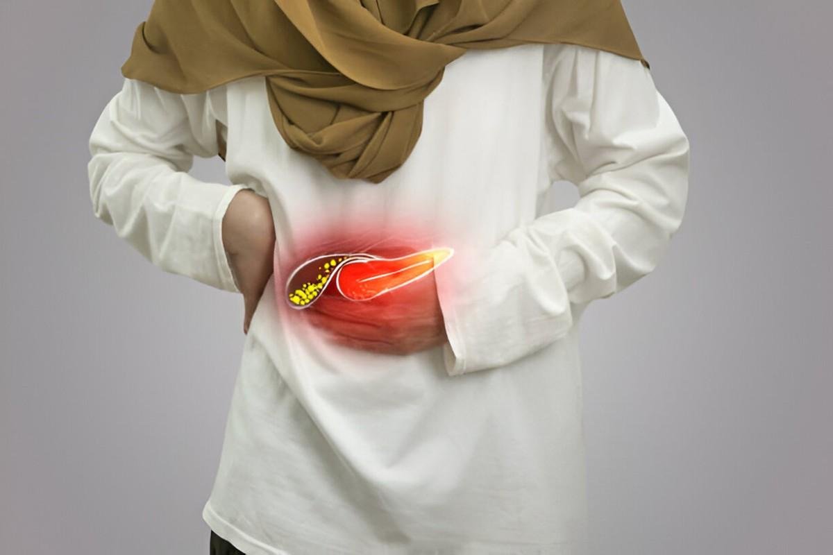 Gallbladder Stones