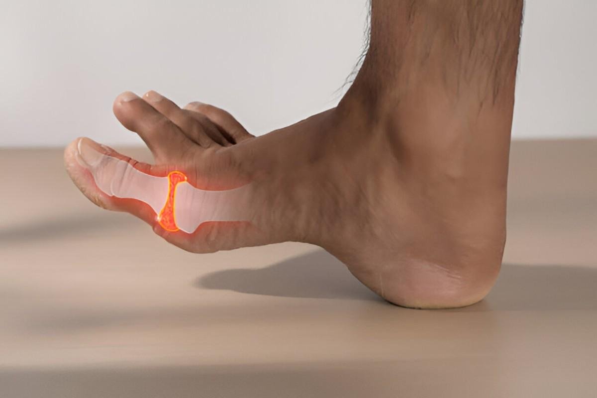 Gout