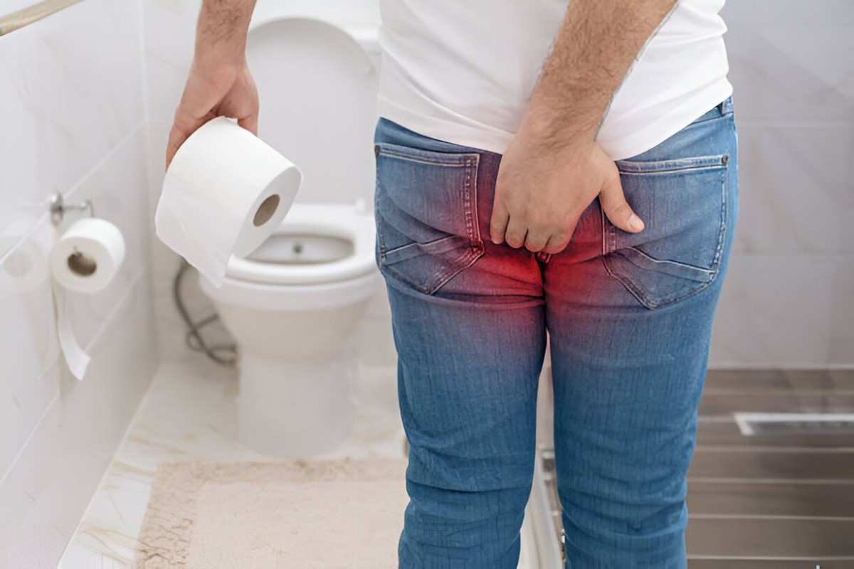 Hemorrhoids
