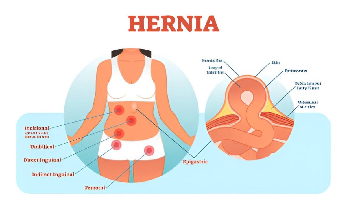 Hernia