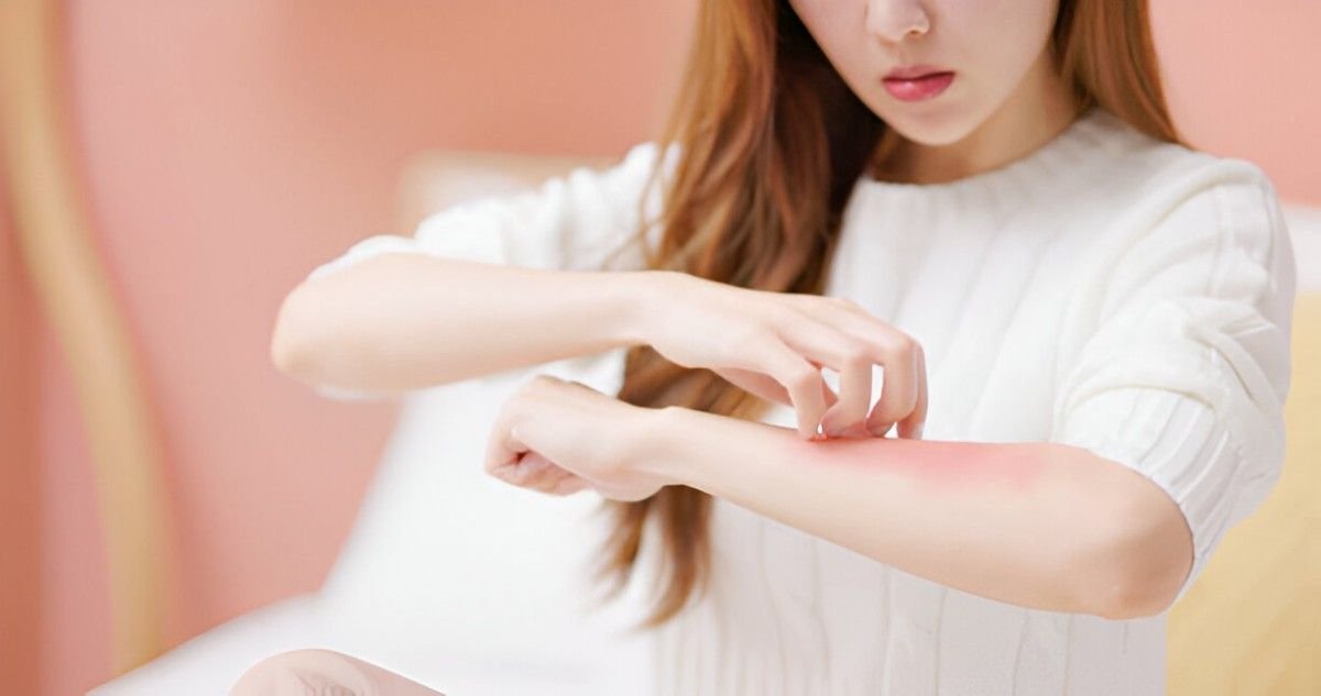 Home Remedies for Eczema Natural Ways to Soothe and Heal