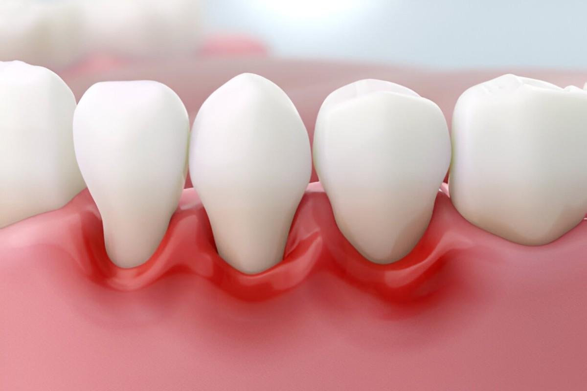 Home Remedies for Gingivitis Natural Solutions for Gum Health