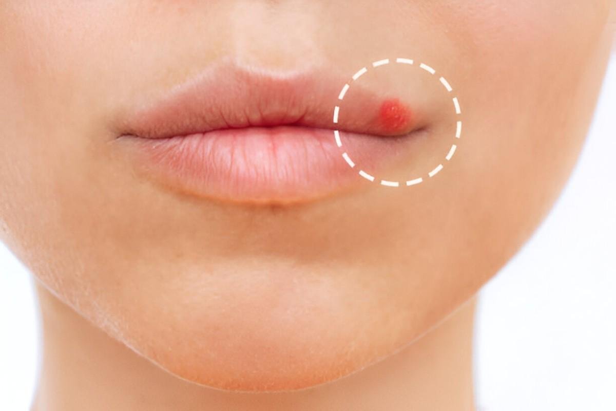 Home Remedies for Herpes Natural Ways to Manage Symptoms