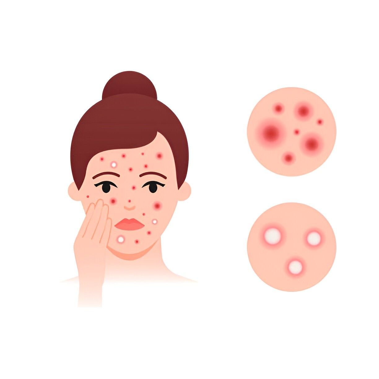 Home Remedies for Warm Compress for Boils