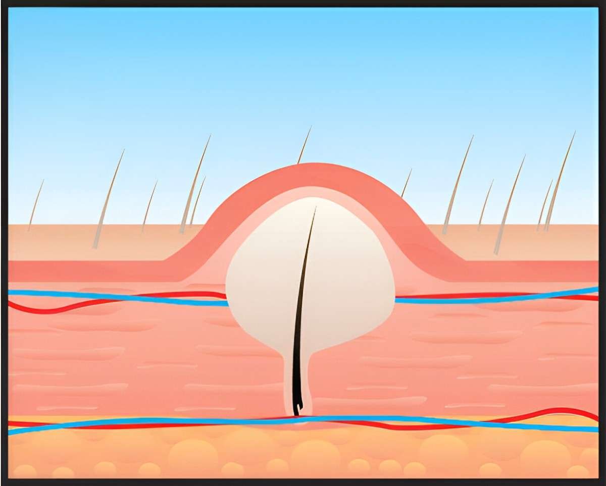Ingrown Hair