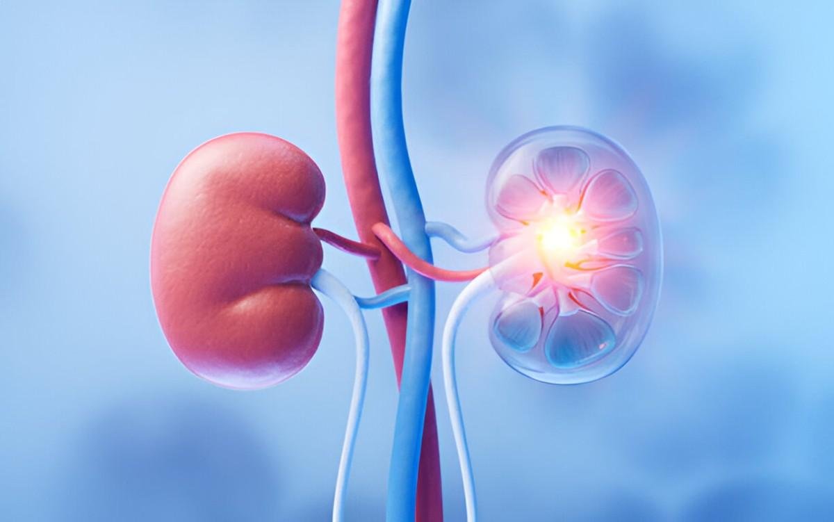 Kidney Infection