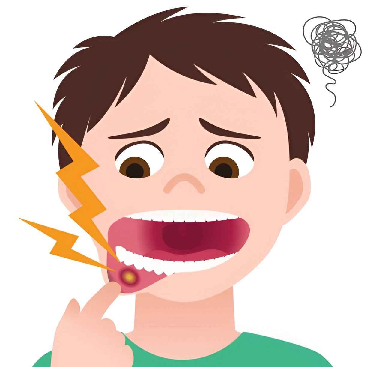 Mouth Ulcer