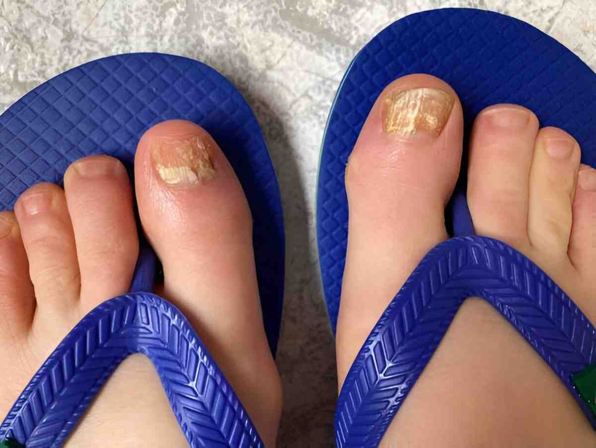 Nail Fungus (2)