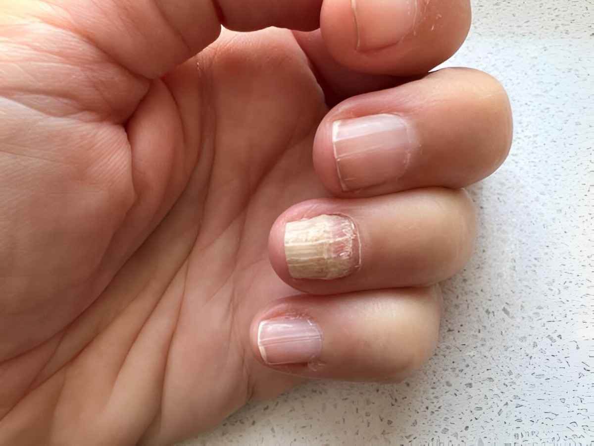 Nail Fungus