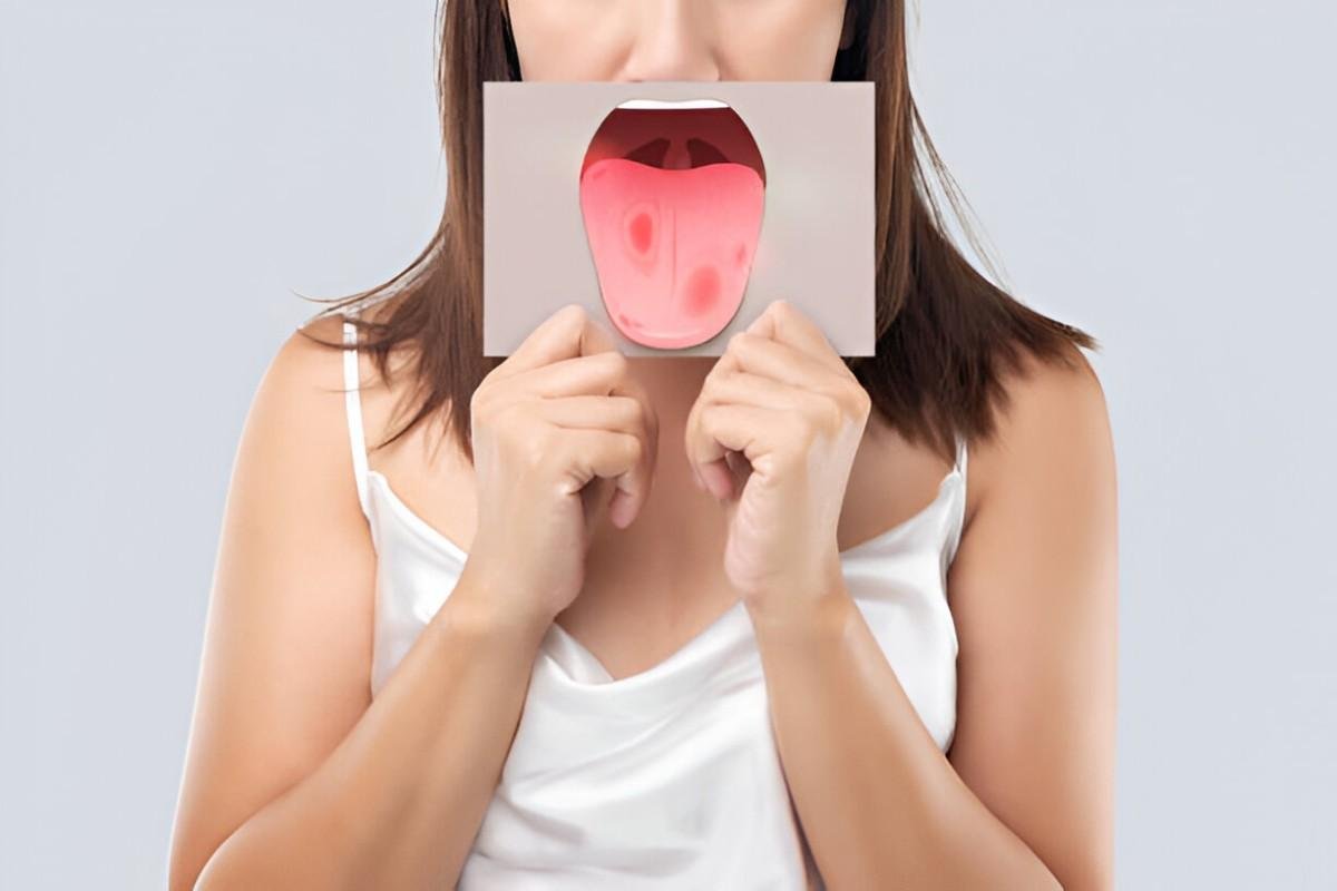 Oral Thrush
