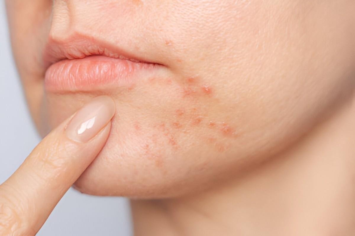 Perioral Dermatitis