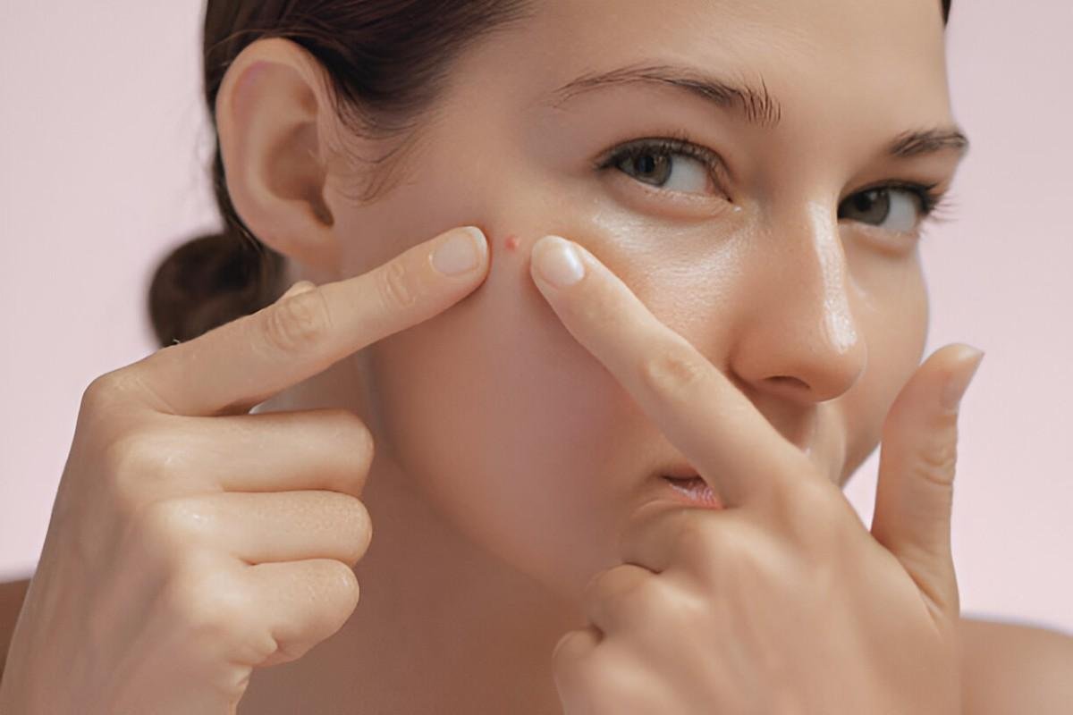 Pimples