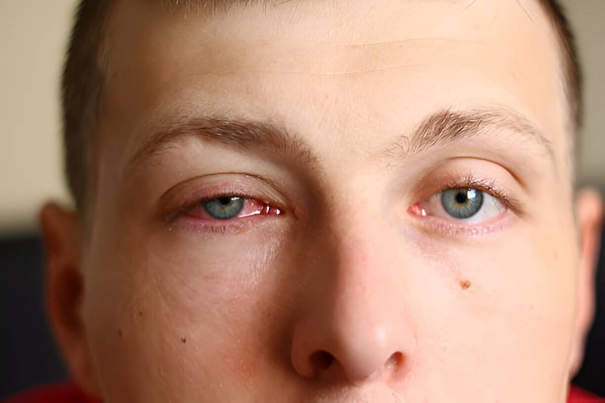Pink Eye in Adults