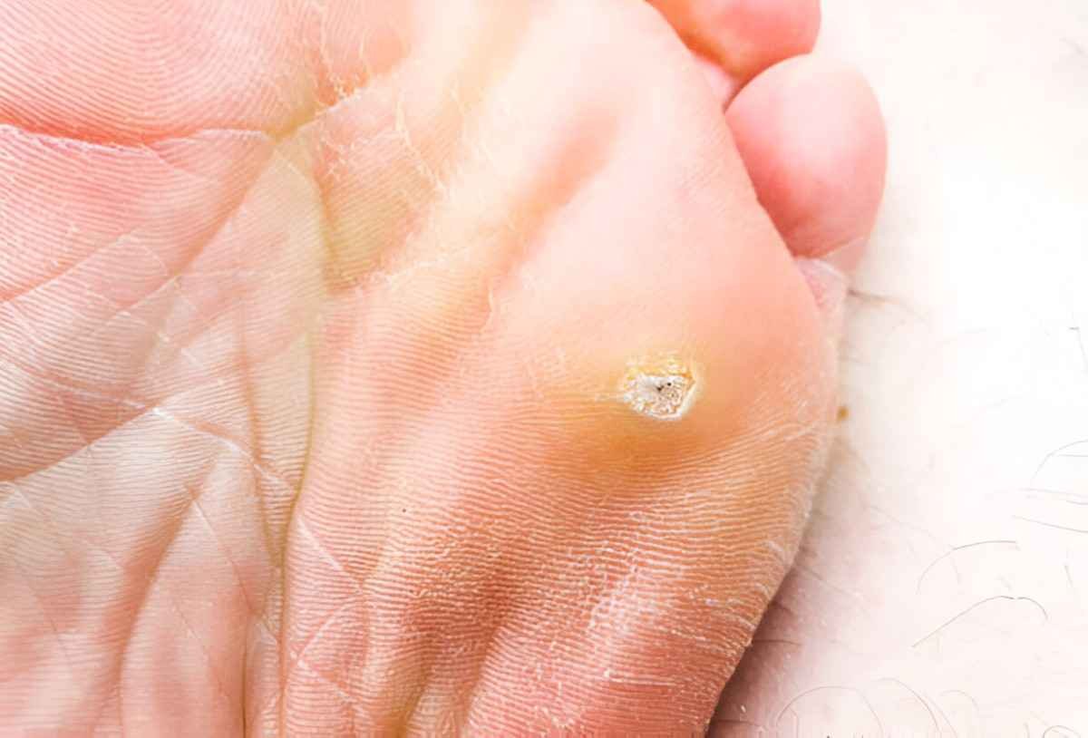 Plantar Warts