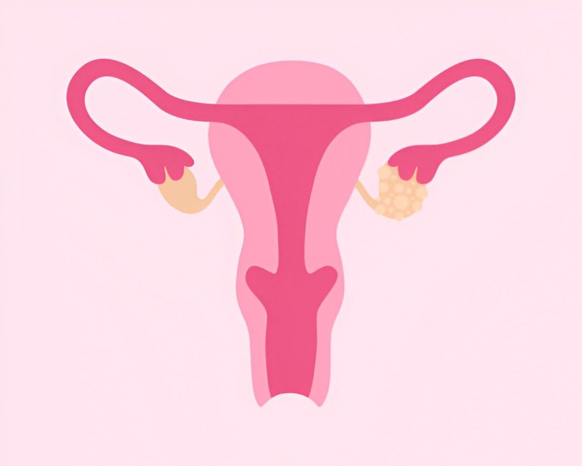Polycystic Ovary Syndrome (2)