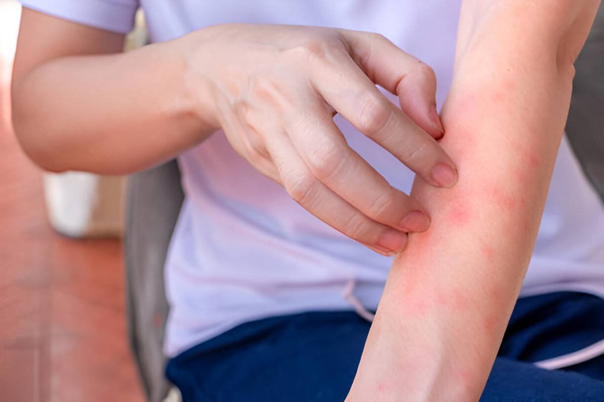 Rashes
