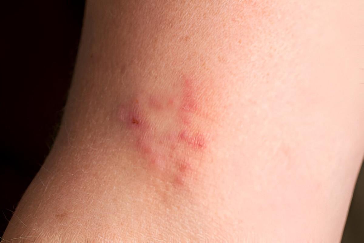 Ringworm Using Tea Tree Oil