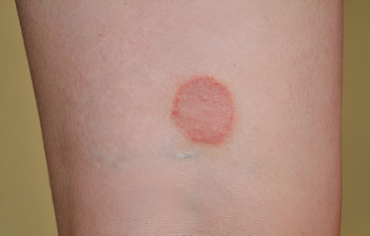 Ringworm