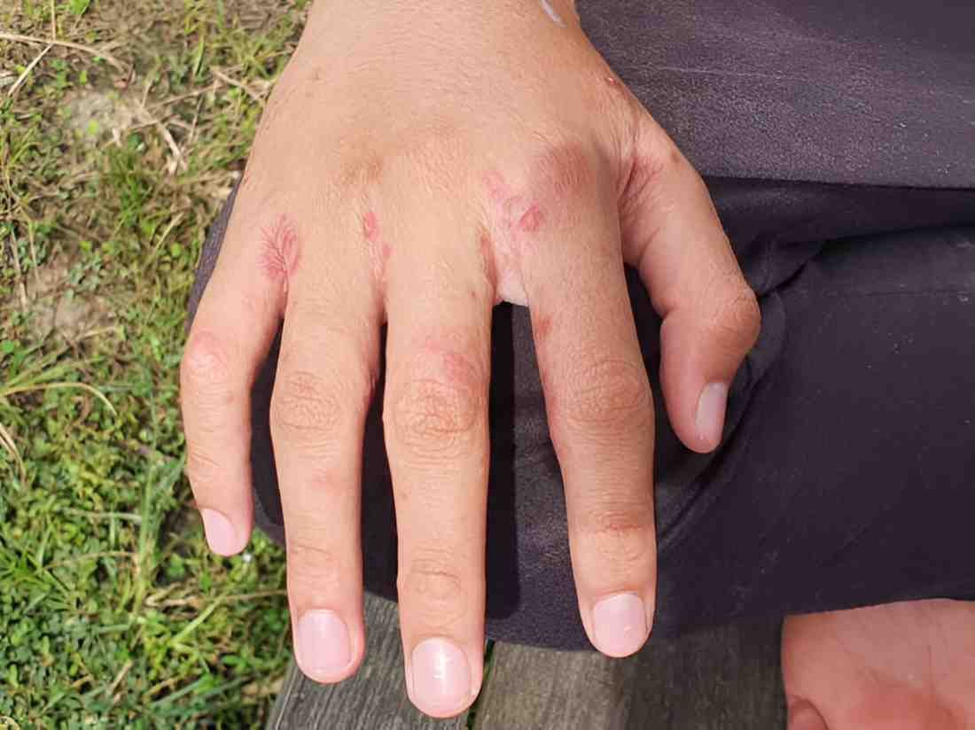 Scabies