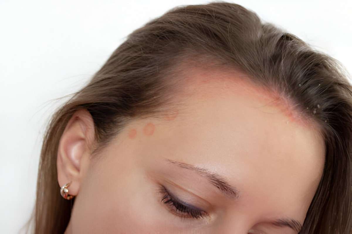 Scalp-Psoriasis