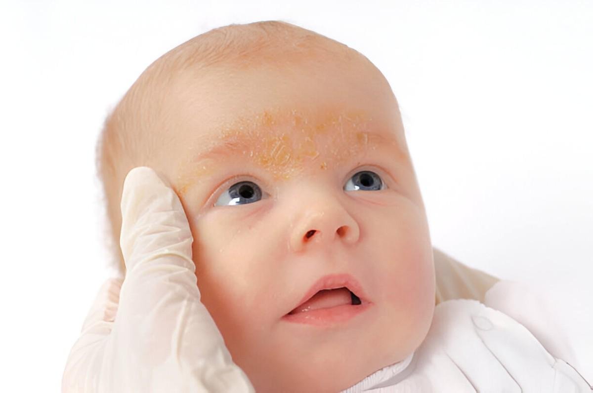 Seborrheic Dermatitis