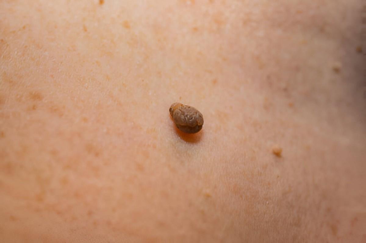 Skin Tags
