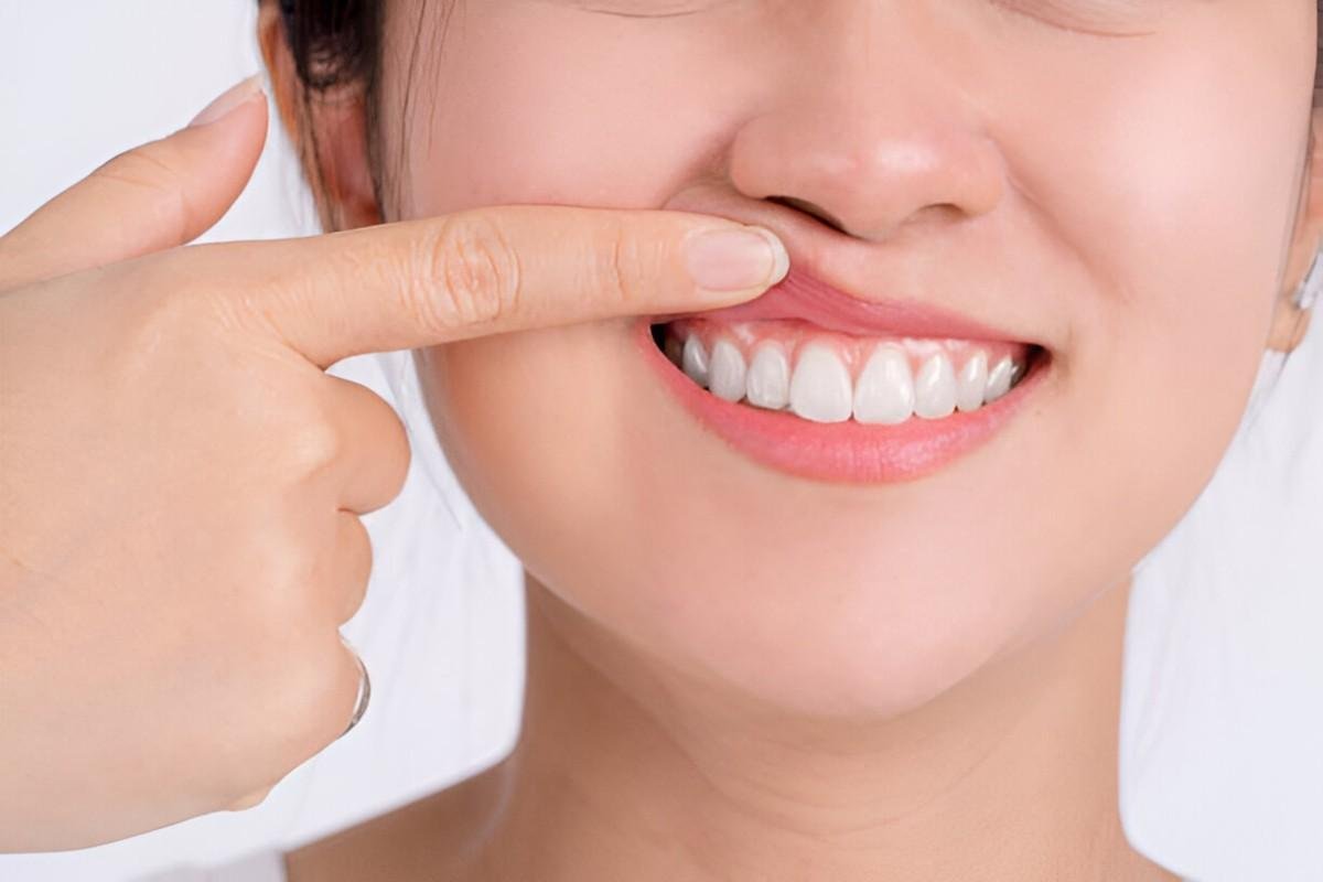 Sore Gums