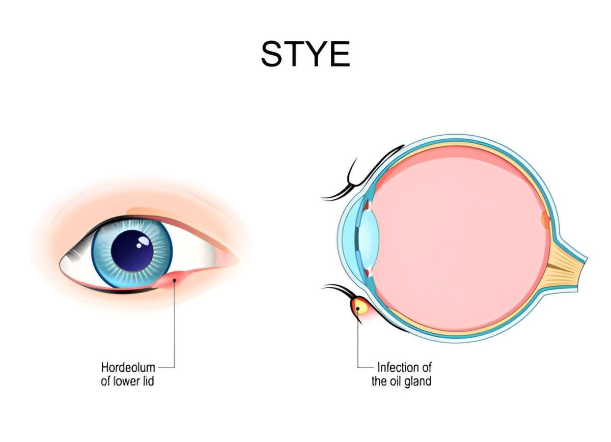 Stye (2)