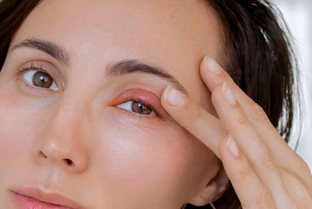 Stye