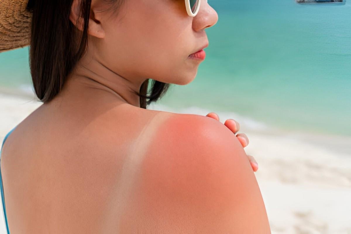 Sunburn